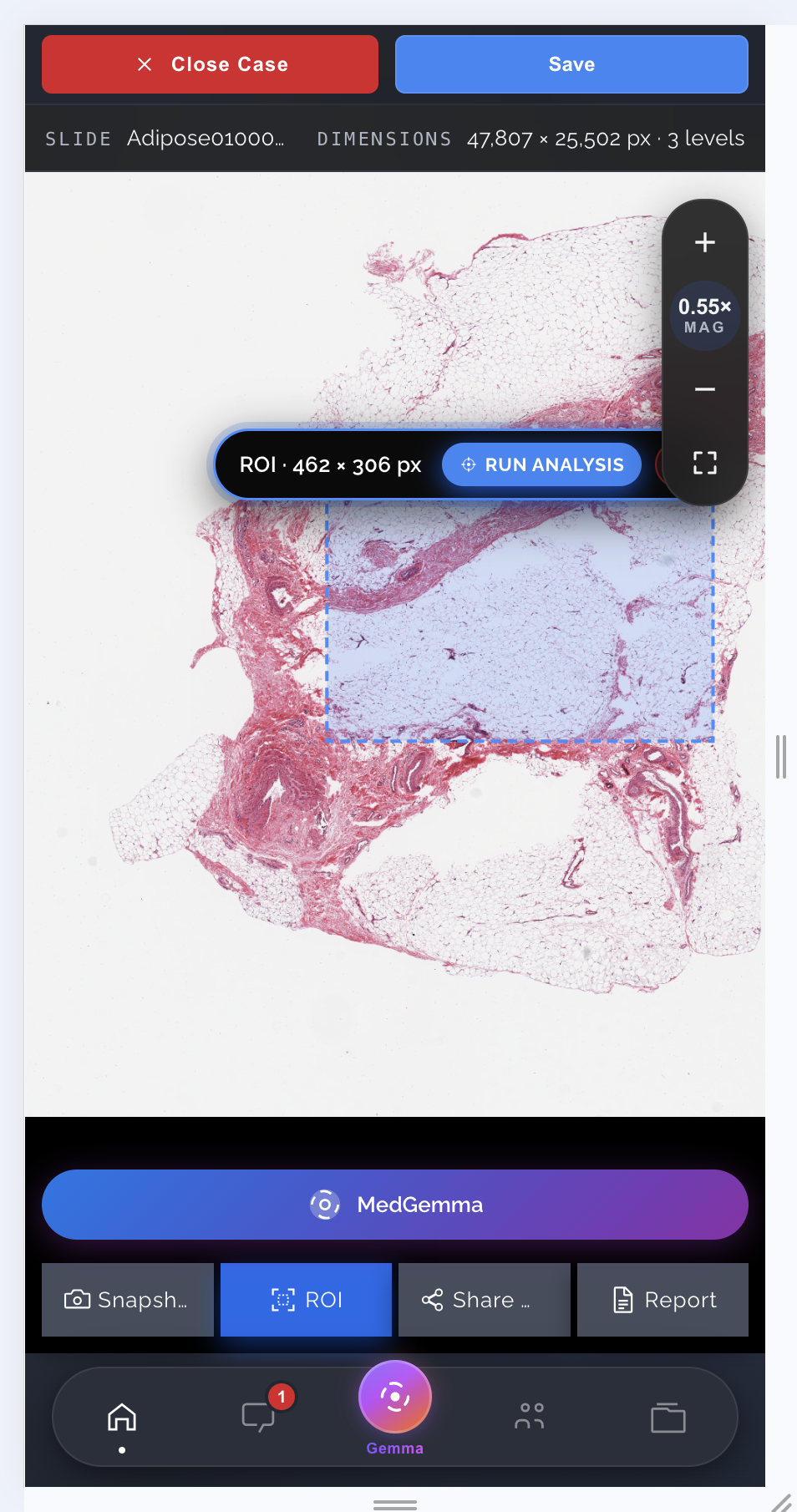 Path-iQ Mobile app — whole slide image WSI viewer with ROI selection and MedGemma AI analysis on iPhone